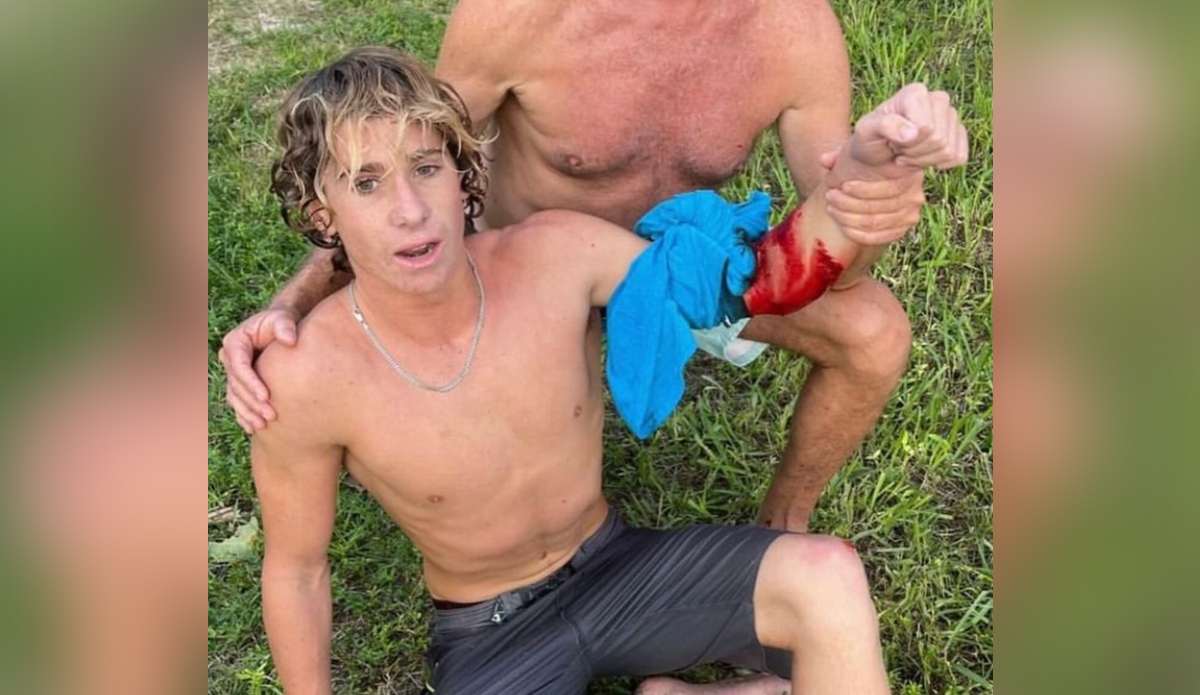 Florida Teen Survives Shark Attack During Surfing Adventure